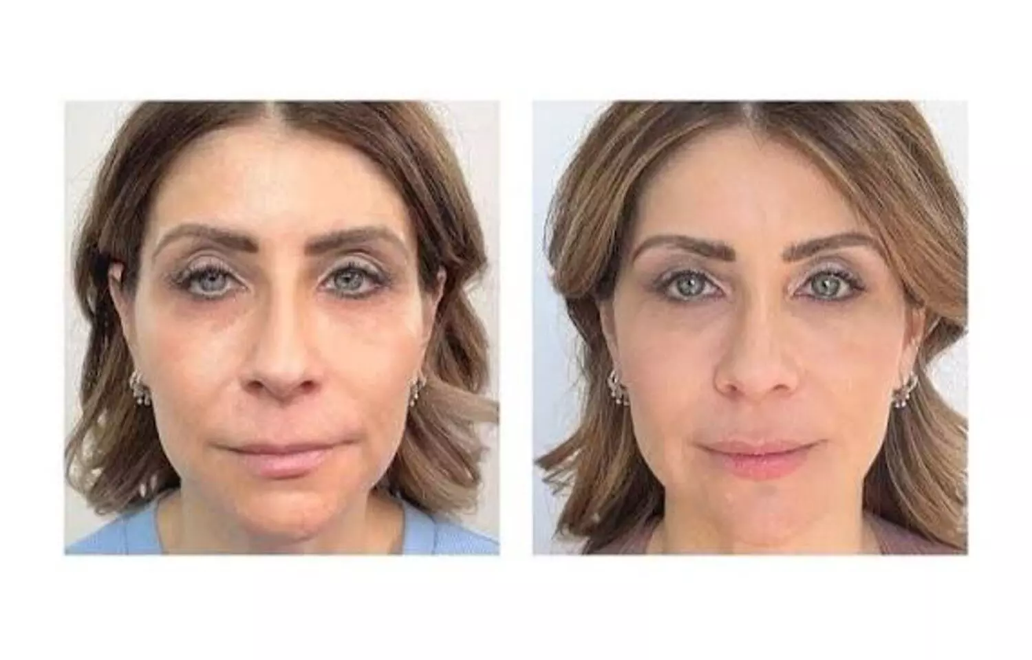 Novel Absorbable Micro-Aesthetic Lifting Thread Demonstrates Effective and Safe Correction of Nasolabial Folds: Study