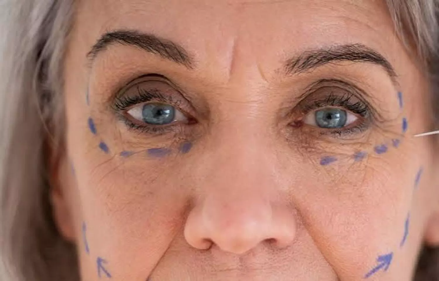Okumus Incision Provides a Hairline-Preserving Option for Female Facelift Surgery, suggests study Okumus Incision Provides a Hairline-Preserving Option for Female Facelift Surgery, suggests study