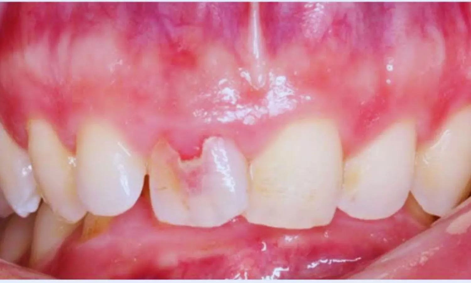 Long-Term Survival of Teeth With External Cervical Resorption Remains Favorable: Study Long-Term Survival of Teeth With External Cervical Resorption Remains Favorable: Study