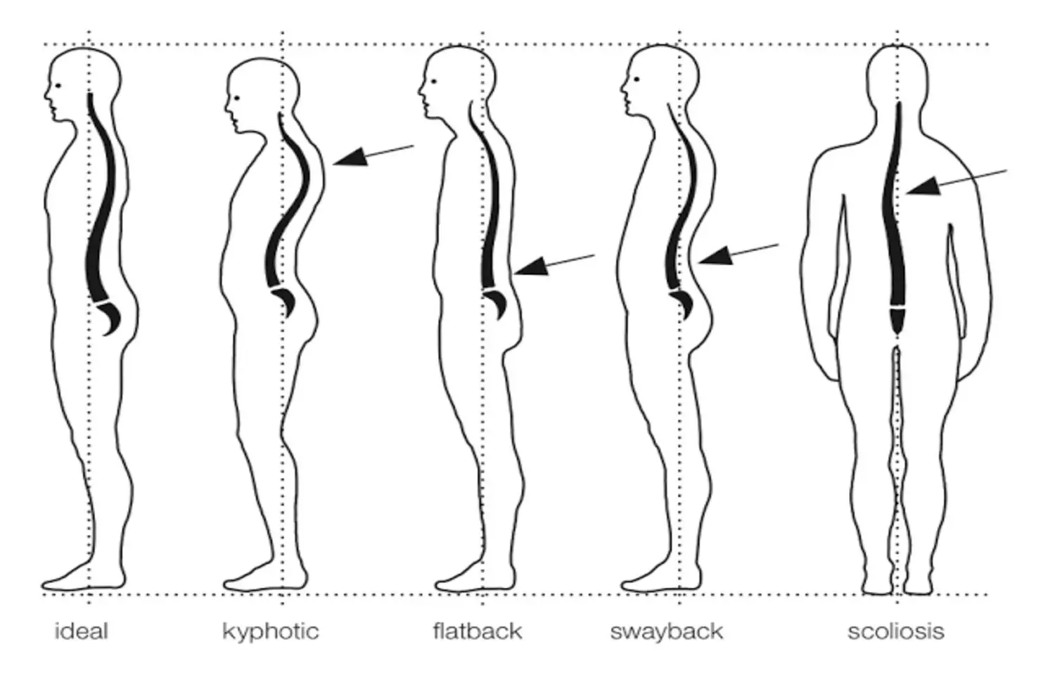 Postural Abnormalities Common and Impact Function in Dialysis Patients: Study Postural Abnormalities Common and Impact Function in Dialysis Patients: Study