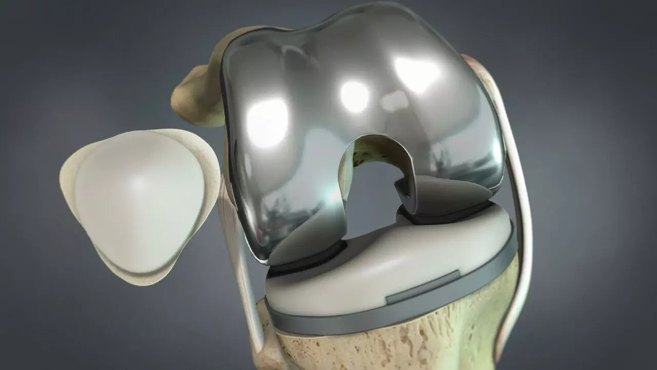 Patellar Resurfacing Lowers Knee Effusion After TKA in Severe Chondrocalcinosis: study