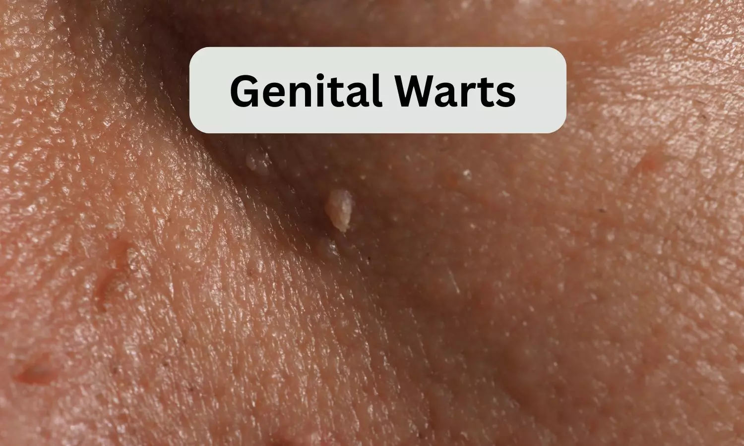Cryotherapy Effective as First-Line Treatment for Genital Warts: Study Cryotherapy Effective as First-Line Treatment for Genital Warts: Study