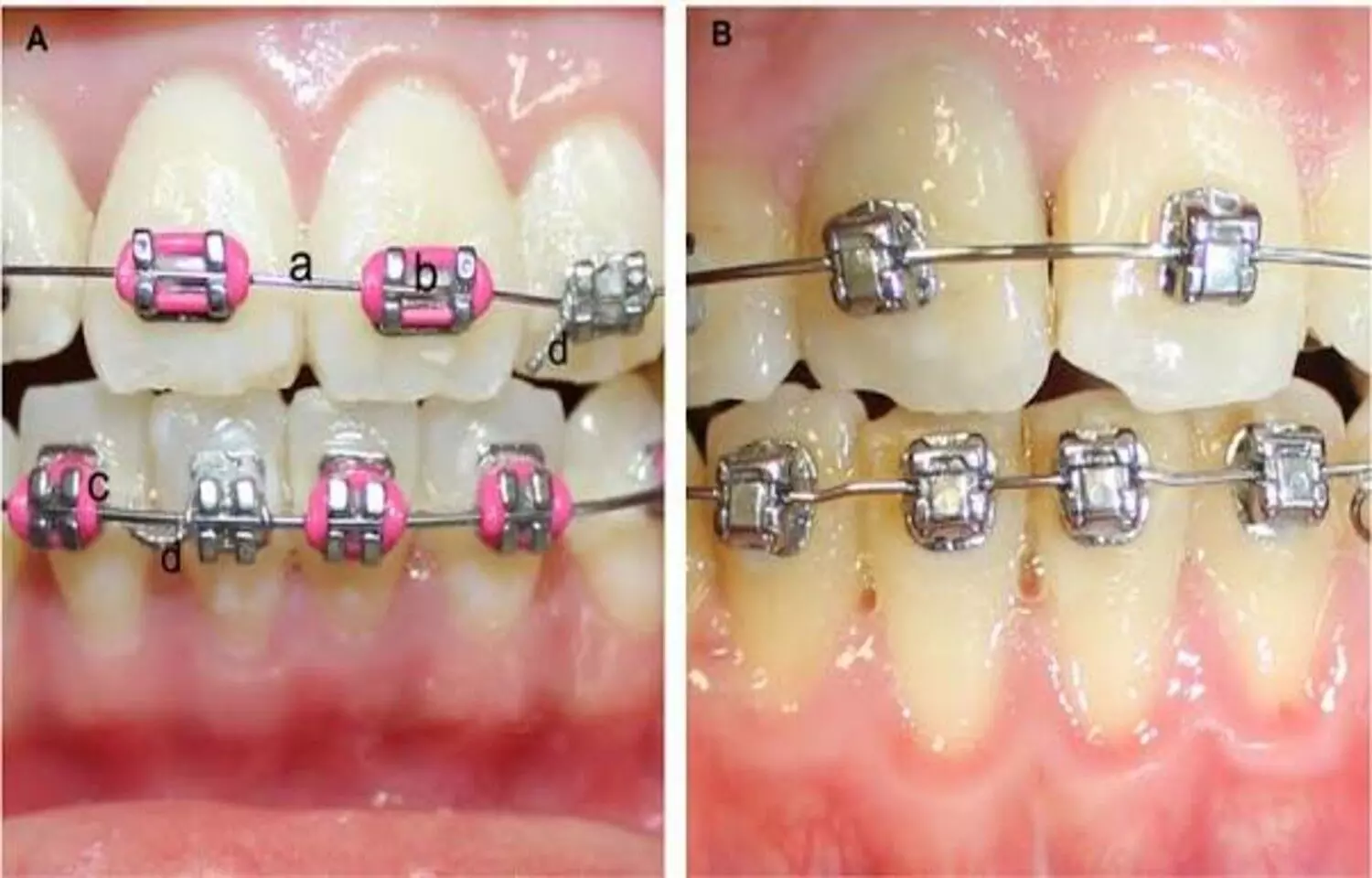 Fixed Orthodontic Appliances Have Limited Impact on oral health and OoL among adolescents: Study Fixed Orthodontic Appliances Have Limited Impact on oral health and OoL among adolescents: Study