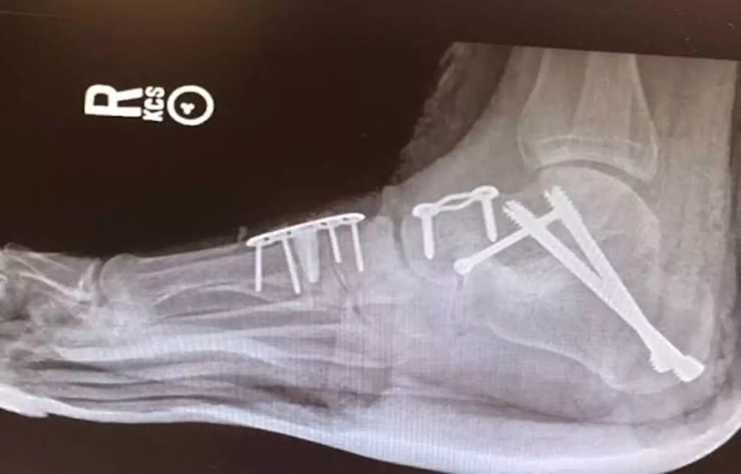 Double Arthrodesis Viable Alternative to Triple Arthrodesis in Selected Patients, suggests study Double Arthrodesis Viable Alternative to Triple Arthrodesis in Selected Patients, suggests study