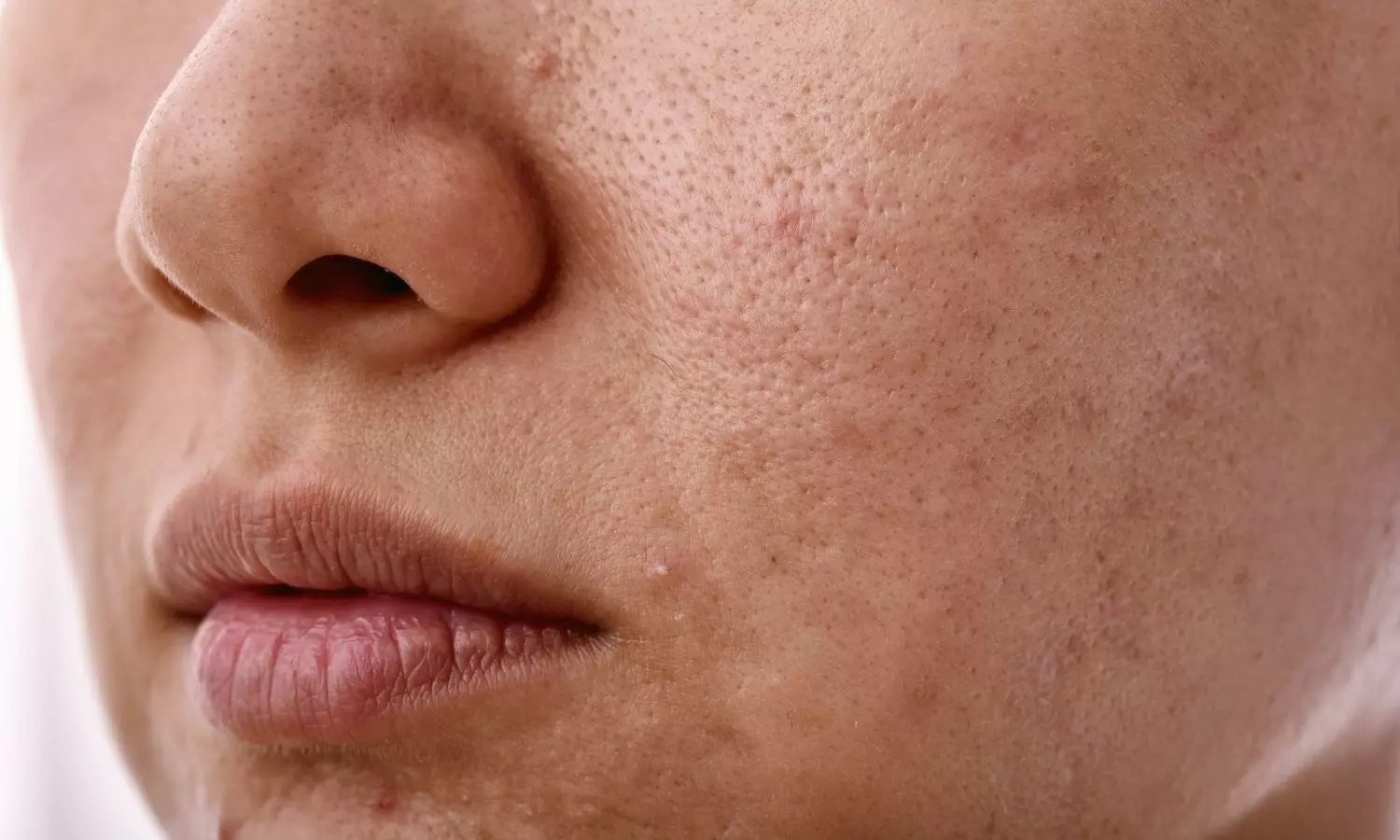 Redefining steroid-induced rosacea: New classification improves treatment outcomes