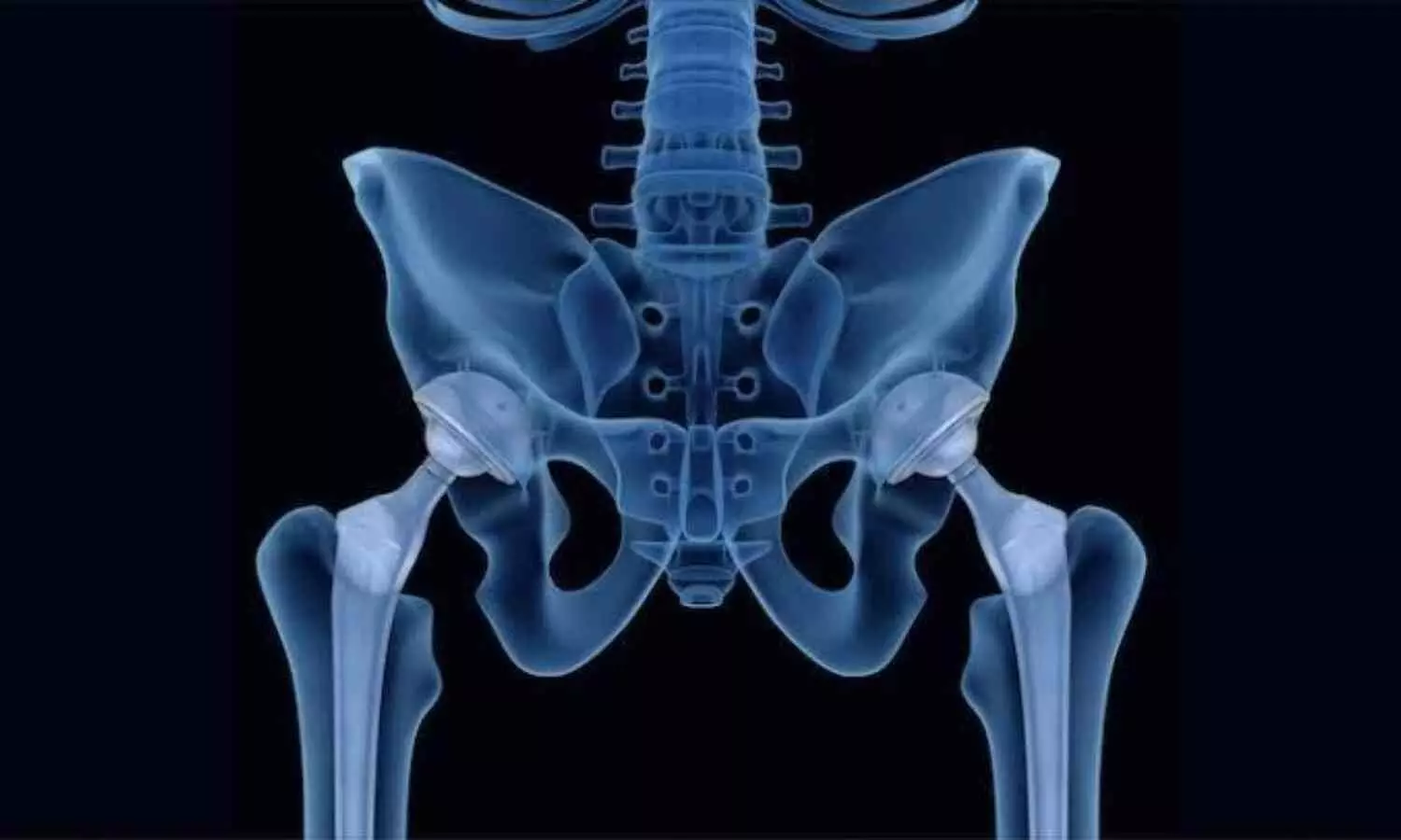 Powered acetabular extraction system linked to significantly reduced extraction times compared with manual extraction in R-THA: study Powered acetabular extraction system linked to significantly reduced extraction times compared with manual extraction in R-THA: study