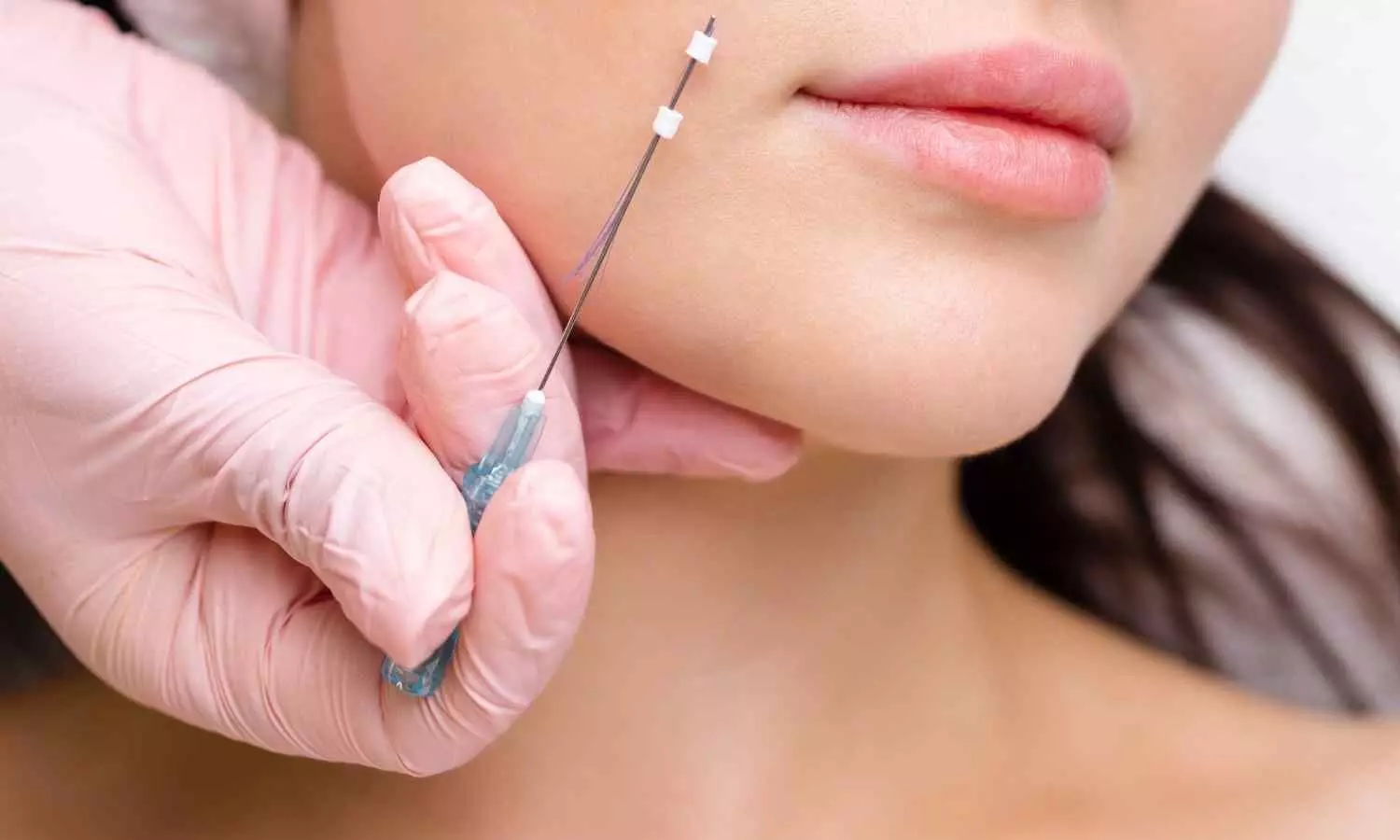Novel Absorbable Micro-Aesthetic Lifting Thread Demonstrates Effective and Safe Correction of Nasolabial Folds: Study