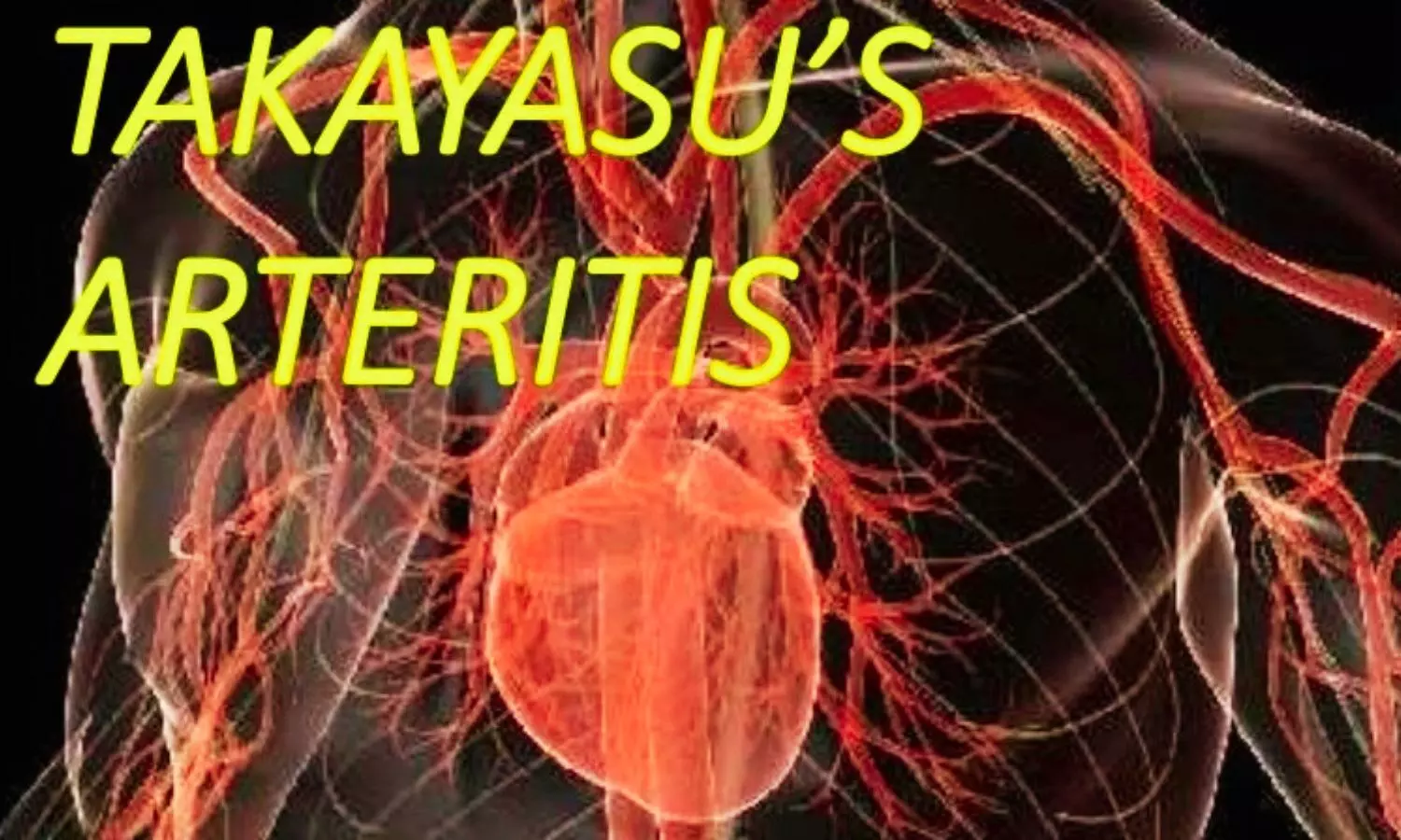 Addition of Leflunomide to Prednisone Fails to Improve Remission in Takayasu Arteritis: Study Addition of Leflunomide to Prednisone Fails to Improve Remission in Takayasu Arteritis: Study