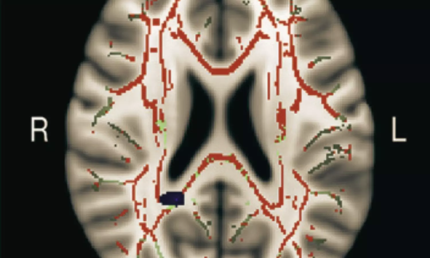 Multidomain Lifestyle Intervention May Slow Brain Aging, Suggests Trial Multidomain Lifestyle Intervention May Slow Brain Aging, Suggests Trial