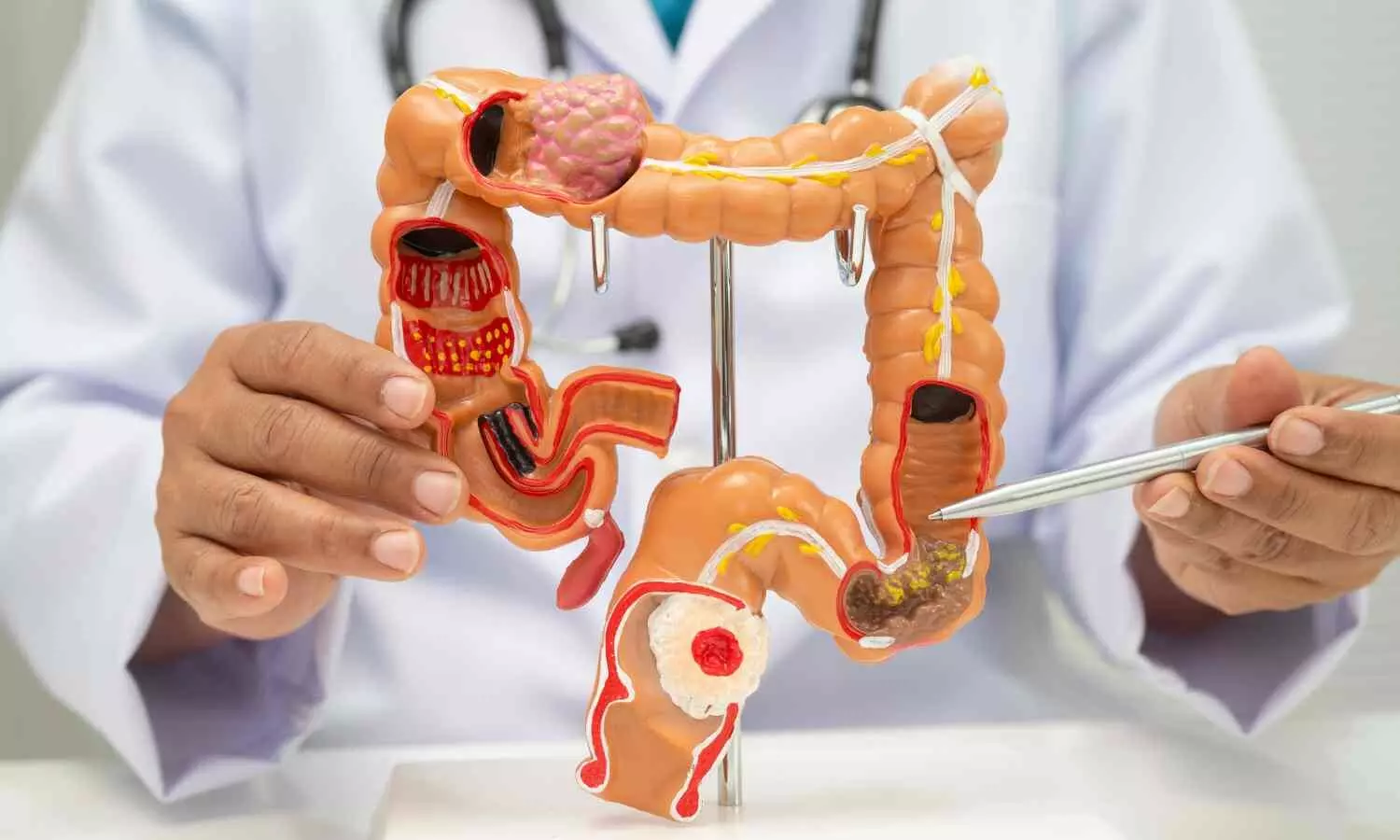 Chronic consumption of xanthan gum may cause inflammation in the colon: Study Chronic consumption of xanthan gum may cause inflammation in the colon: Study