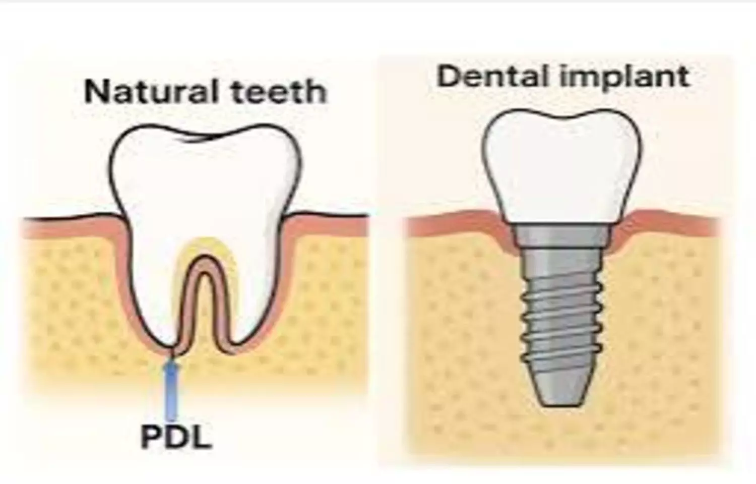 Adjacent Teeth Generally Maintain Pulp Health After Dental Implant Placement, suggests study