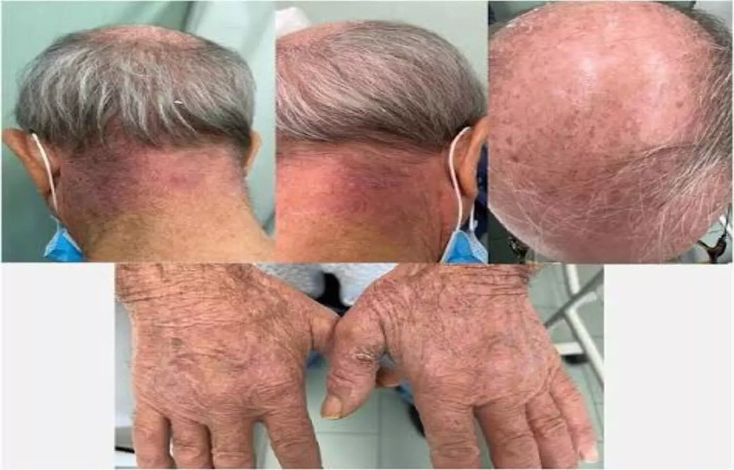 Dupilumab-Associated Vitiligo Is Rare but Requires Early Recognition, finds study Dupilumab-Associated Vitiligo Is Rare but Requires Early Recognition, finds study