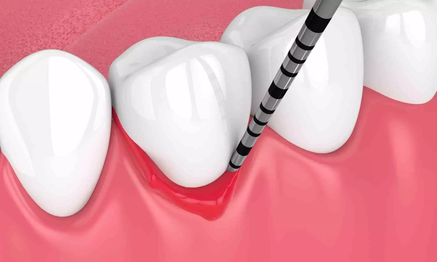 NSAID Use Associated With Reduced Periodontal Bone Loss in Postmenopausal Women, suggests study NSAID Use Associated With Reduced Periodontal Bone Loss in Postmenopausal Women, suggests study