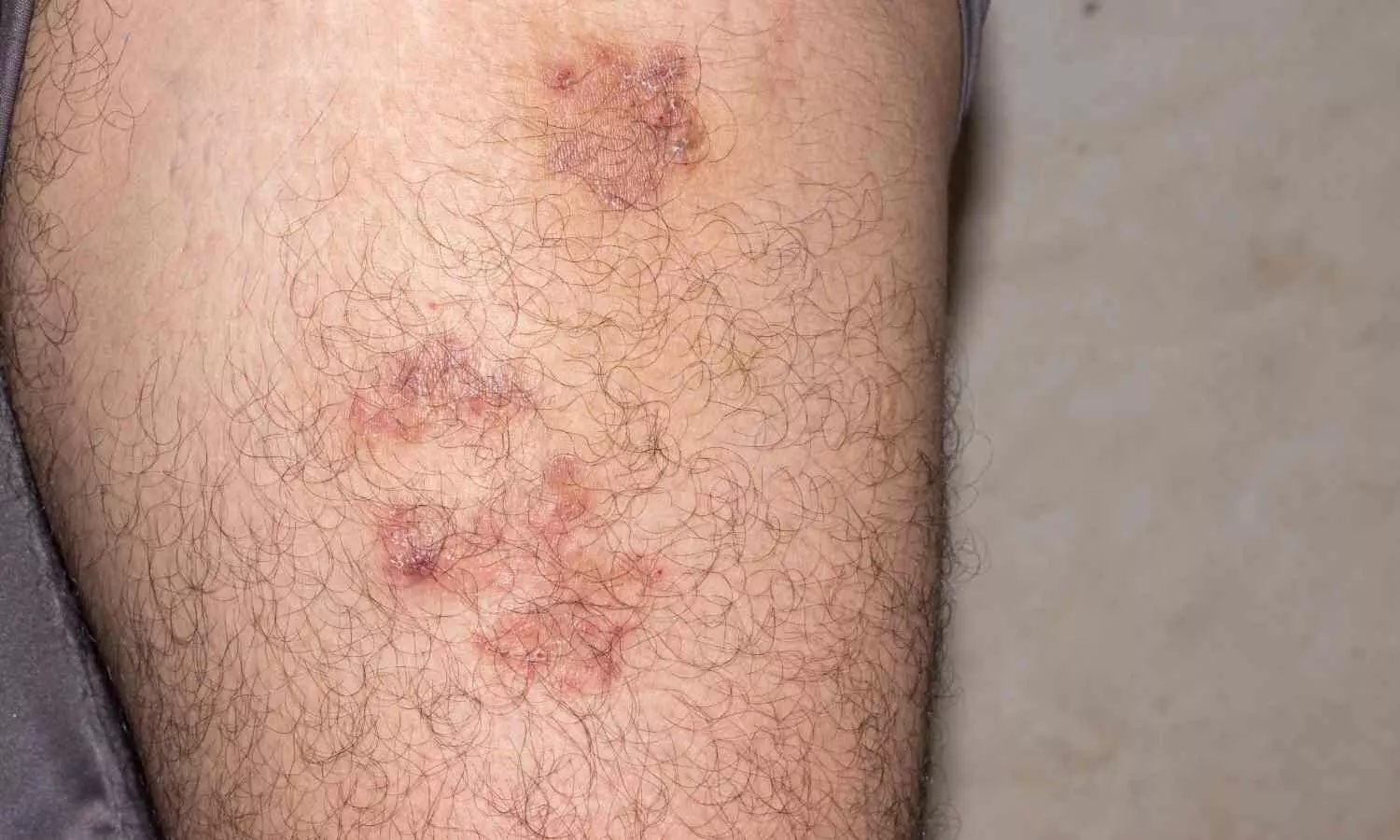 Daratumumab Shows Promise for Rituximab-Refractory Pemphigus, suggests study Daratumumab Shows Promise for Rituximab-Refractory Pemphigus, suggests study