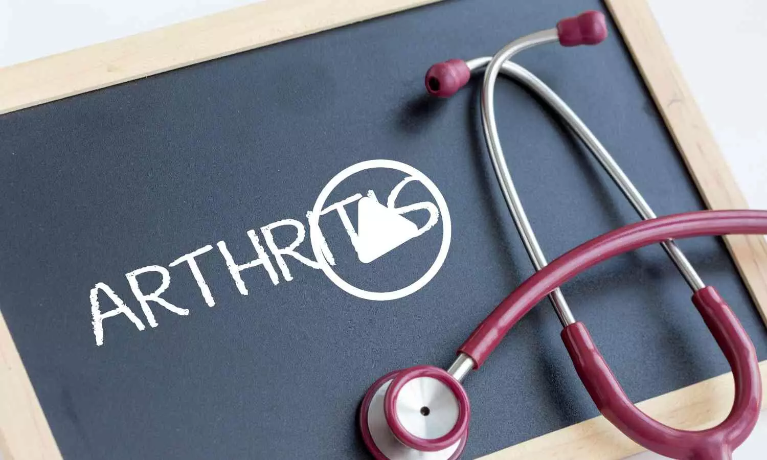 Researchers Explore Ultrasound Therapy to Prevent Arthritis Before Disease Develops