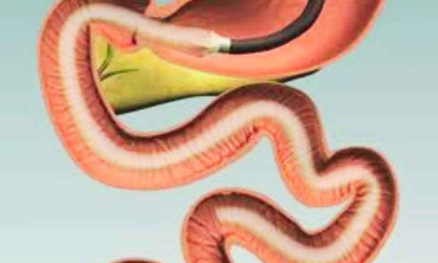 Duodenal–Jejunal Bypass Liners Improve Diabetes Control but Raise Safety Concerns, Suggests Research