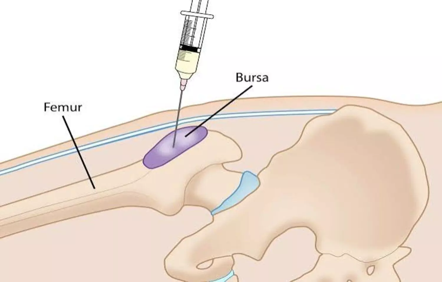 Corticosteroid Injections Provide Short-Term Relief in Hip Osteoarthritis, finds study Corticosteroid Injections Provide Short-Term Relief in Hip Osteoarthritis, finds study