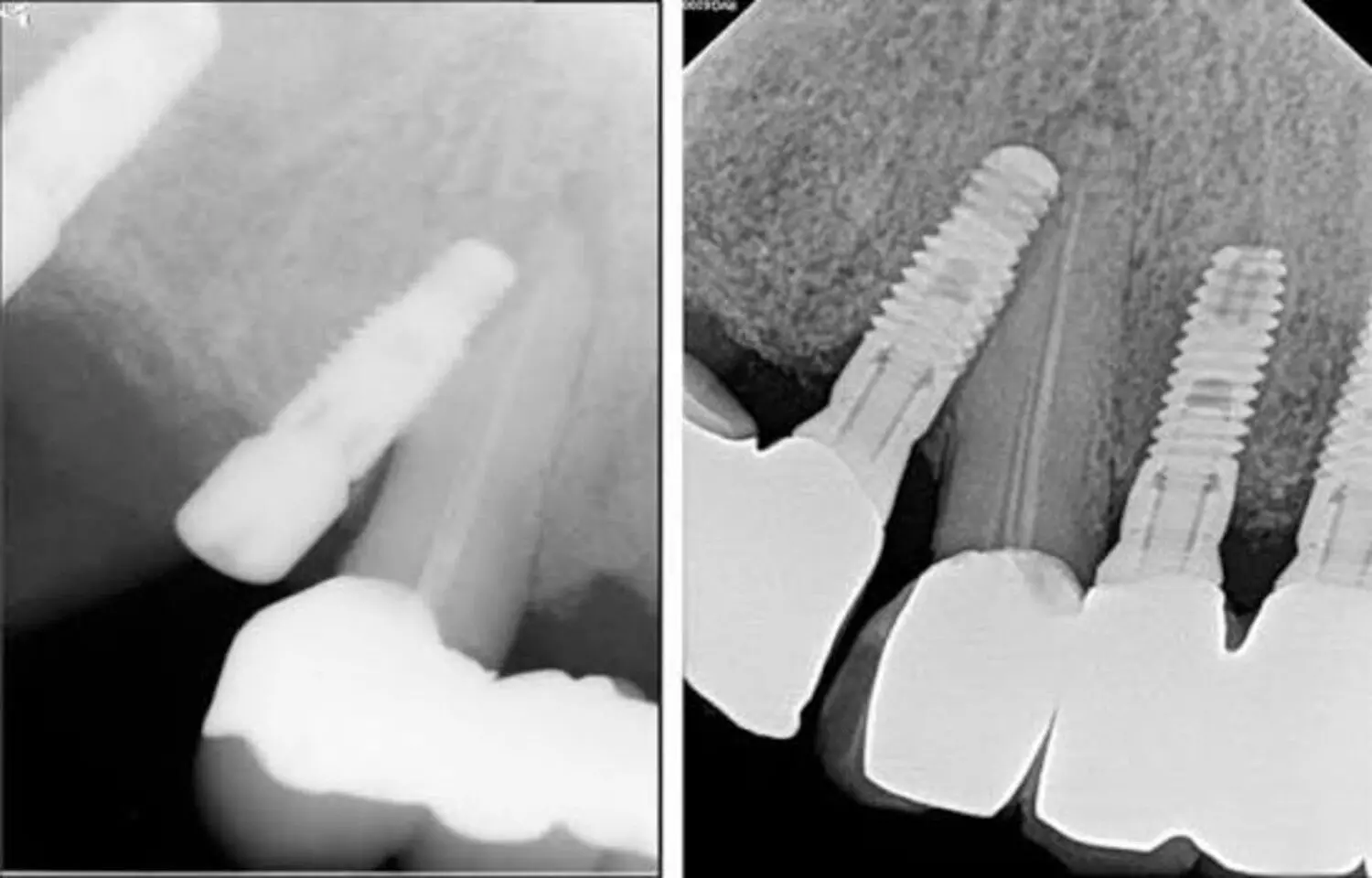 Resveratrol Shows Promise as an Adjunct in Periodontal Therapy, suggests study