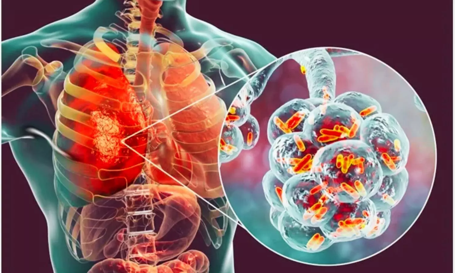 Higher Mortality With Plasma Transfusion in Severe Pneumonia Largely Explained by Illness Severity: Study Higher Mortality With Plasma Transfusion in Severe Pneumonia Largely Explained by Illness Severity: Study