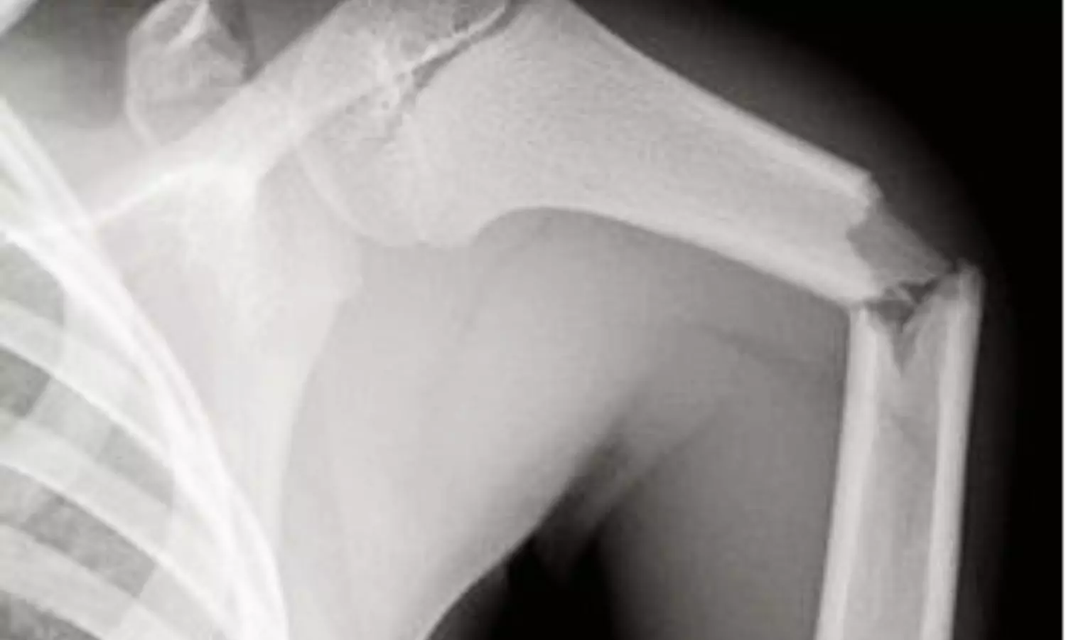 Pediatric Humeral Shaft Fractures: Distal, Oblique Patterns May Increase Risk of Poor Radial Nerve Outcomes, Finds Review