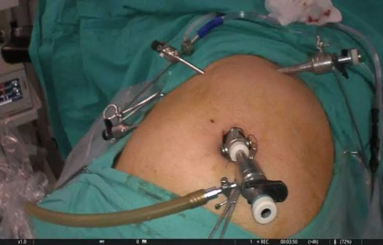 Intraoperative ICG Improves Safety and Outcomes in Laparoscopic Cholecystectomy: JAMA