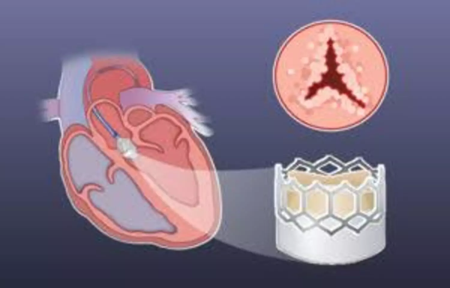 Exercise Testing may  Help identify patients needing prompt treatment in  Asymptomatic Severe AS: JAMA