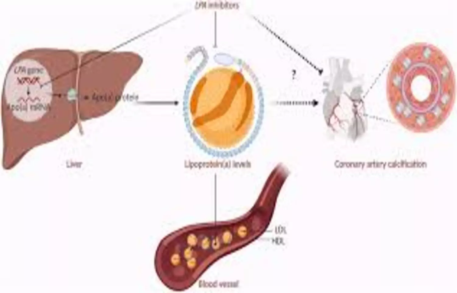 Imaging-Detected Pulp Calcification Associated with Diabetes and Atherosclerotic Disease: Study Imaging-Detected Pulp Calcification Associated with Diabetes and Atherosclerotic Disease: Study