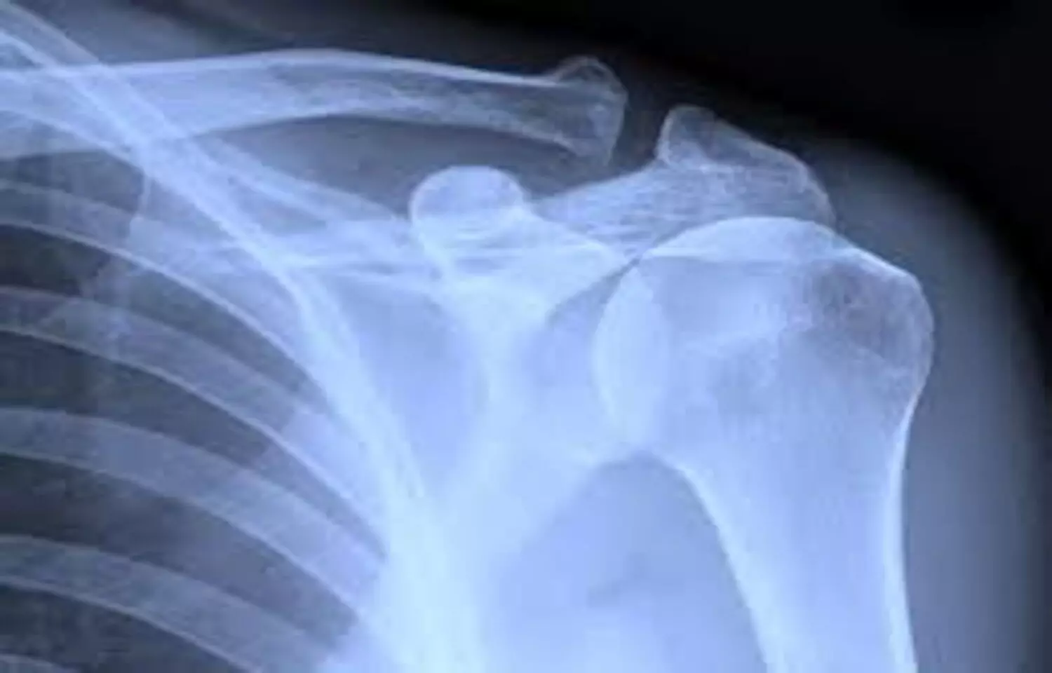 Oral tranexamic acid Safe and Effective Alternative to IV tranexamic acid  in Shoulder Arthroplasty: Study