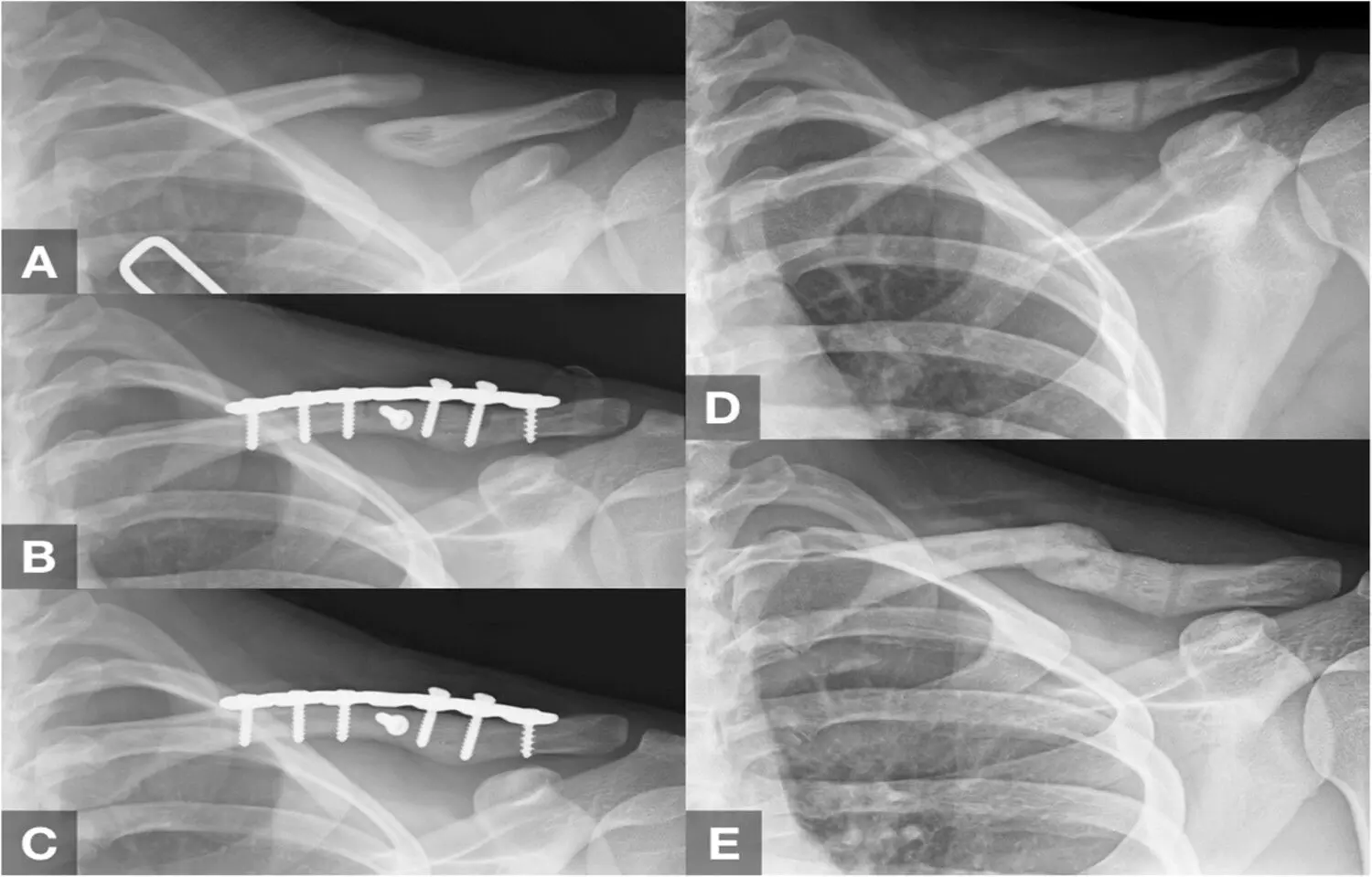 Complex Midshaft Fractures Increase Refracture Risk After Clavicle Implant Removal: Study