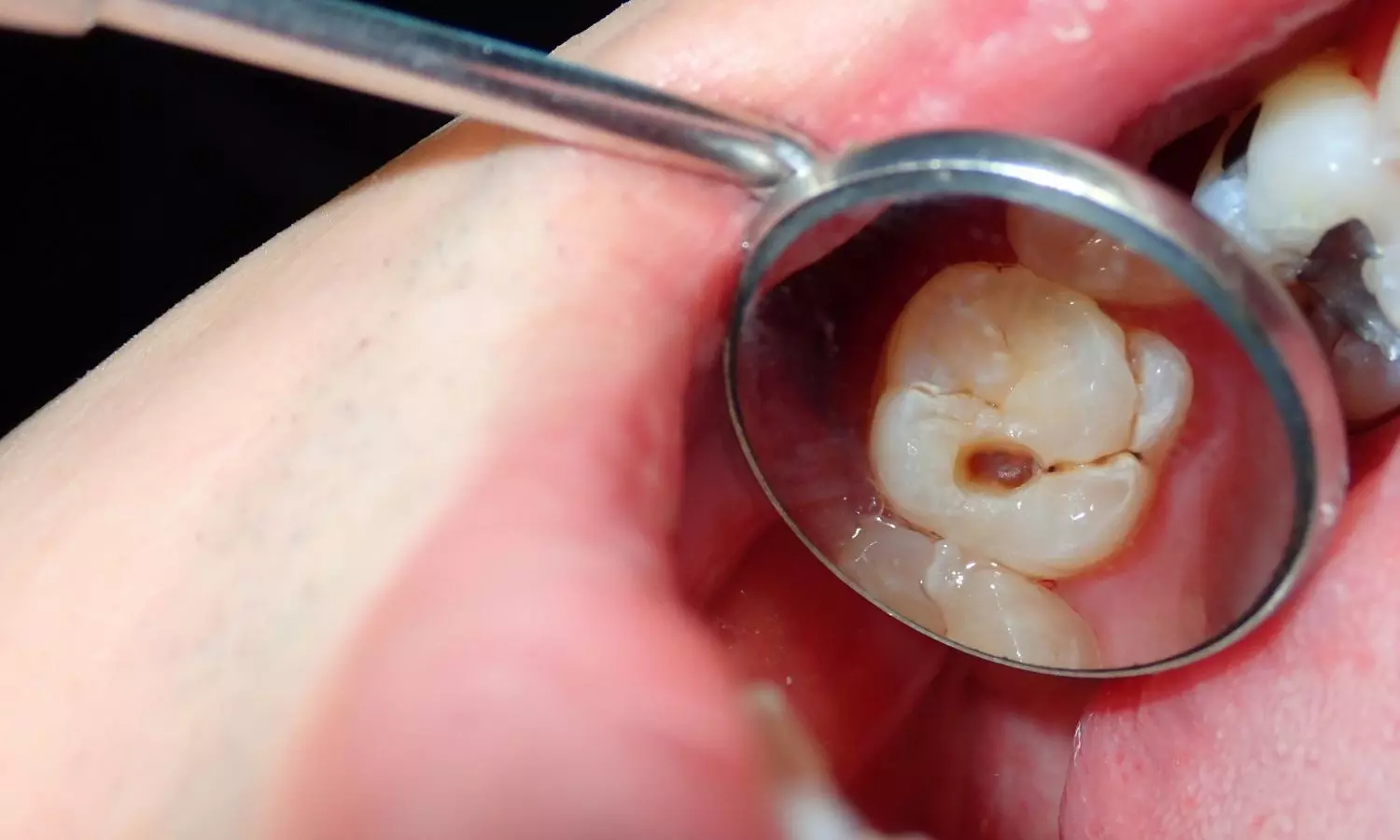 Goodbye, cavities? New gel could regrow tooth enamel Goodbye, cavities? New gel could regrow tooth enamel