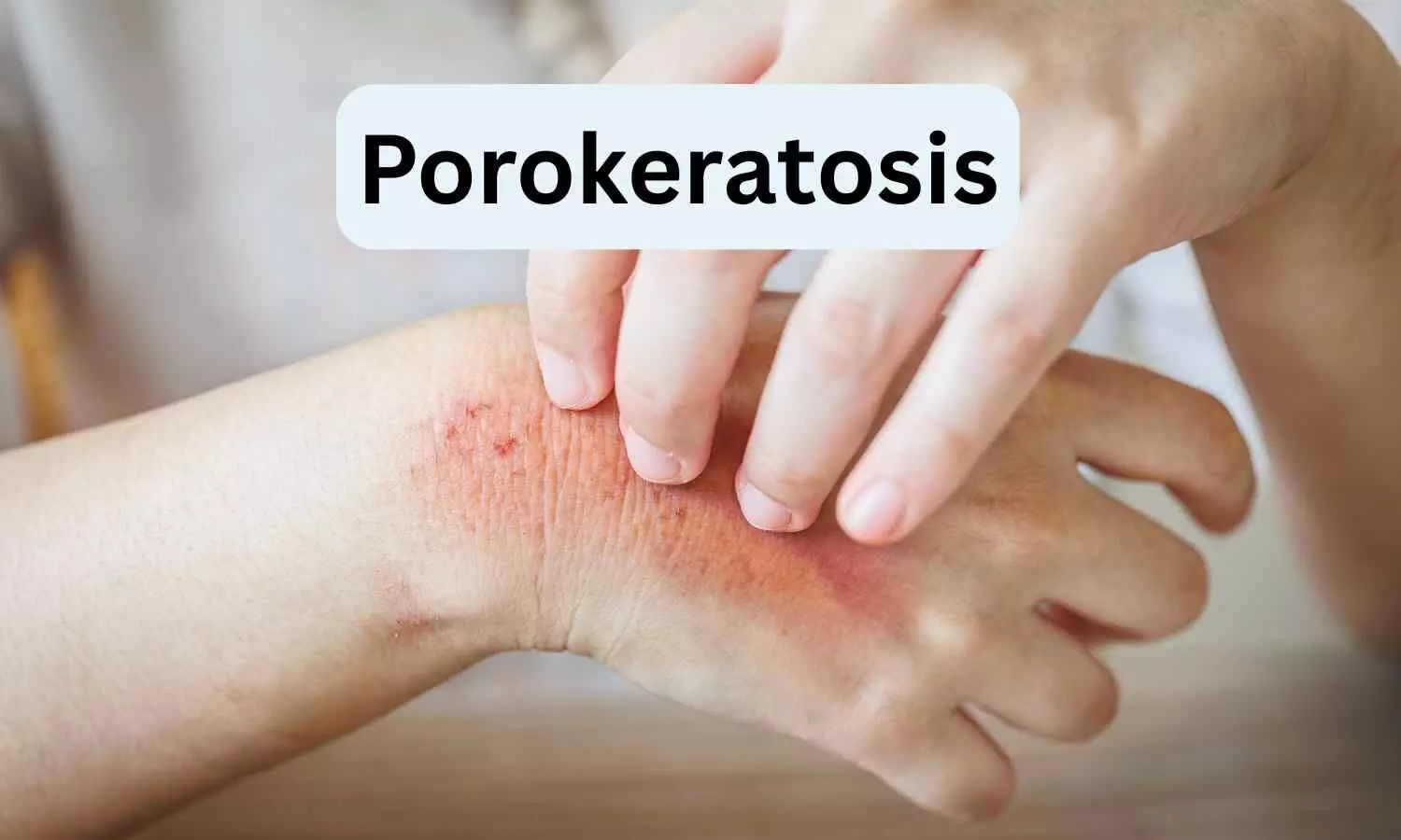 Topical Statins Show Promise as a Safe Treatment for Porokeratosis: A case report Topical Statins Show Promise as a Safe Treatment for Porokeratosis: A case report