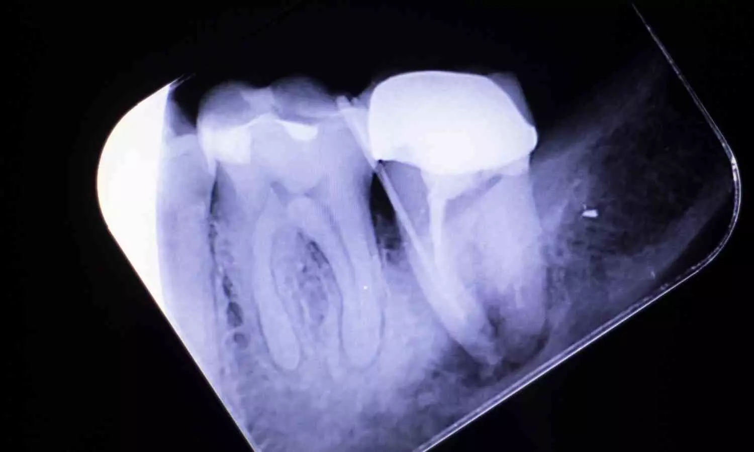 Imaging-Detected Pulp Calcification Associated with Diabetes and Atherosclerotic Disease: Study