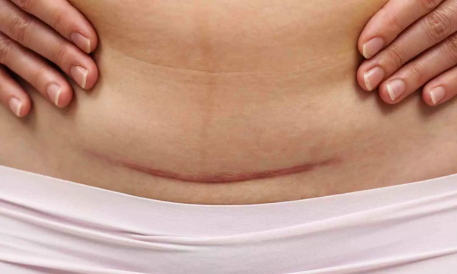 Breakthrough Trial Reveals Biomechanics-Based Suturing Improves Cesarean Scar Outcomes