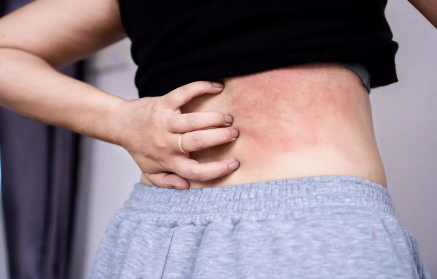 Anrikefon Improves Pruritus in Diabetic Hemodialysis Patients: Study