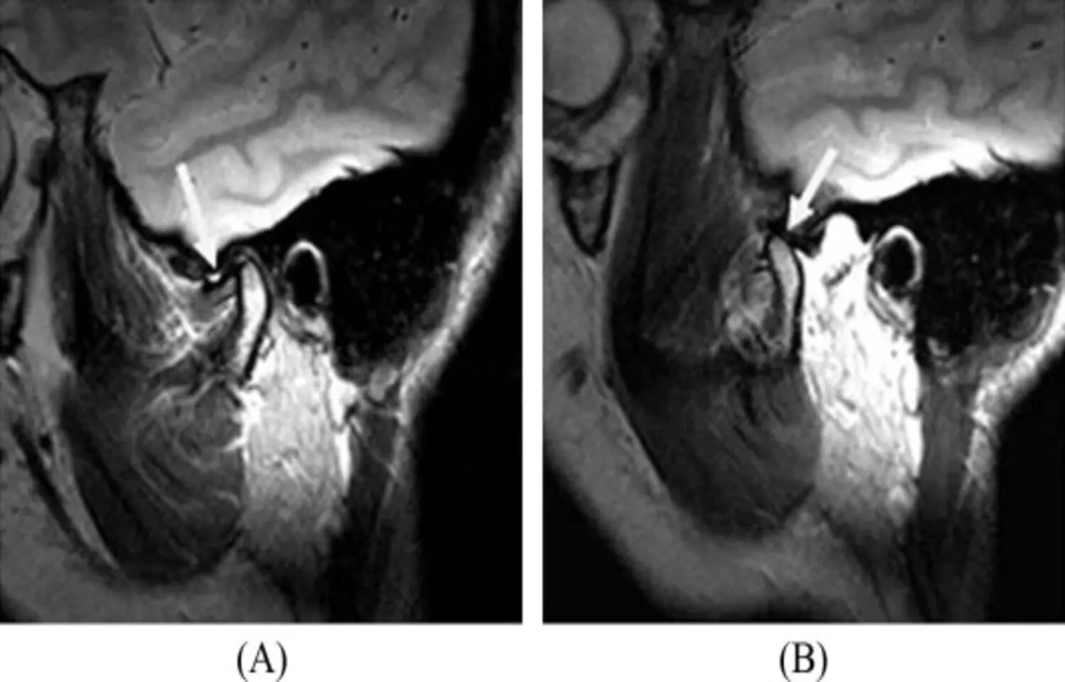 MRI-Detected TMJ Effusion Correlates With Pain Severity and Jaw Dysfunction: Study MRI-Detected TMJ Effusion Correlates With Pain Severity and Jaw Dysfunction: Study