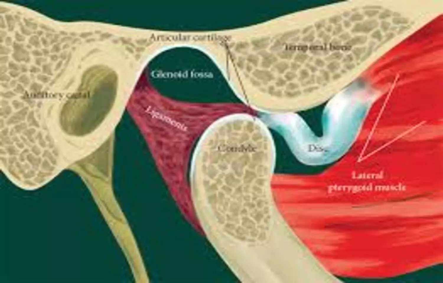 Surgery May Preserve Condylar Height and Improve Degenerative Changes in ADDWoR of TMJ: Study Surgery May Preserve Condylar Height and Improve Degenerative Changes in ADDWoR of TMJ: Study