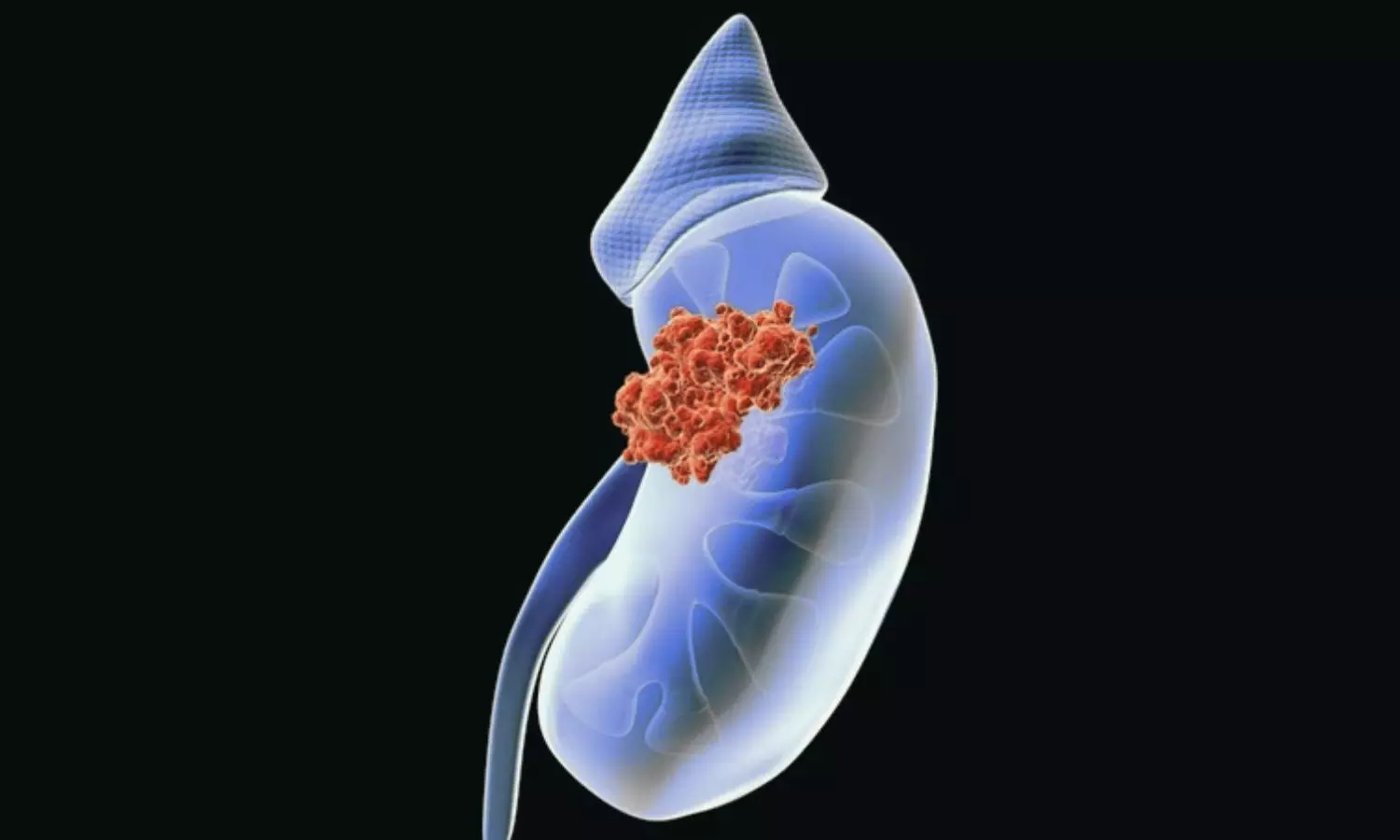 Enfortumab Vedotin–Related Skin Toxicities Predict Better Survival in Advanced Urothelial Cancer: JAMA