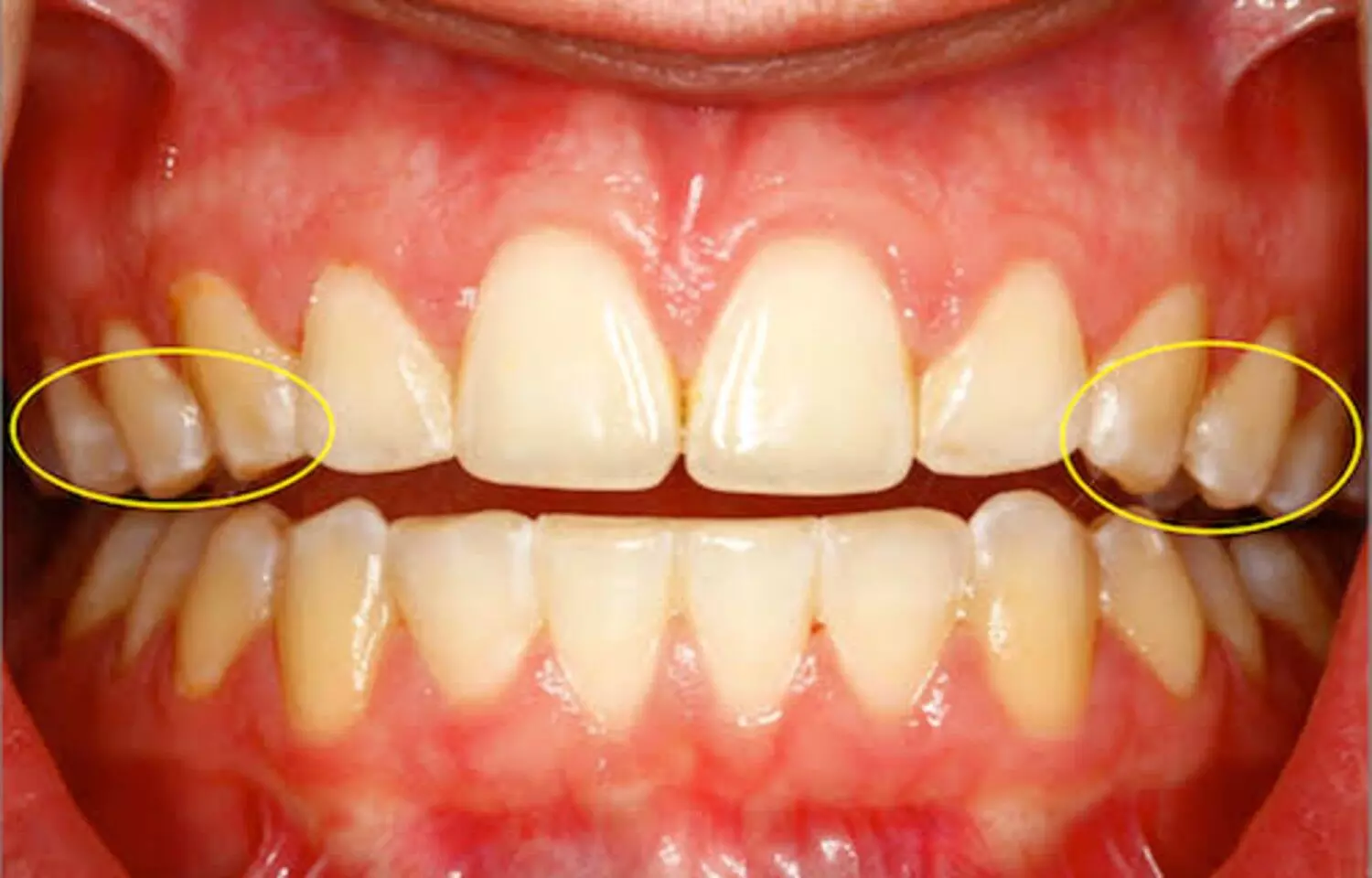 Fluoride-Enhanced Orthodontic Wax May Help Reverse White Spot Lesions: Study Fluoride-Enhanced Orthodontic Wax May Help Reverse White Spot Lesions: Study