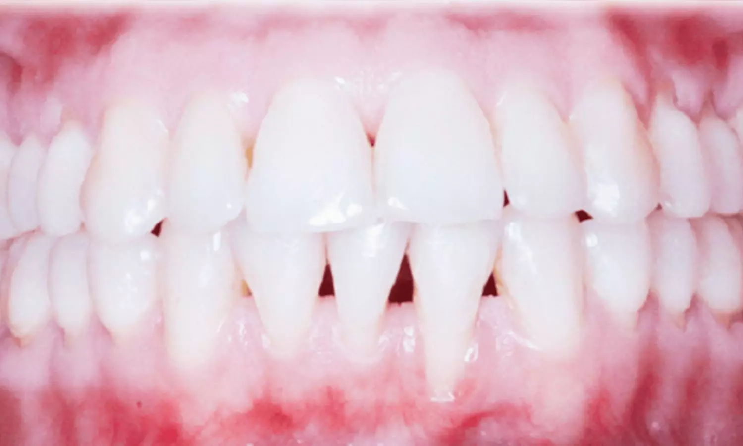 Connective Tissue Graft With Coronally Advanced Flap Successfully Treats Orthodontic-Related Gingival Recession: Case Report Connective Tissue Graft With Coronally Advanced Flap Successfully Treats Orthodontic-Related Gingival Recession: Case Report