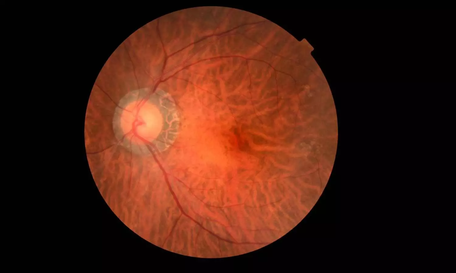 A drop that can save the sight of extremely premature babies, suggests study A drop that can save the sight of extremely premature babies, suggests study