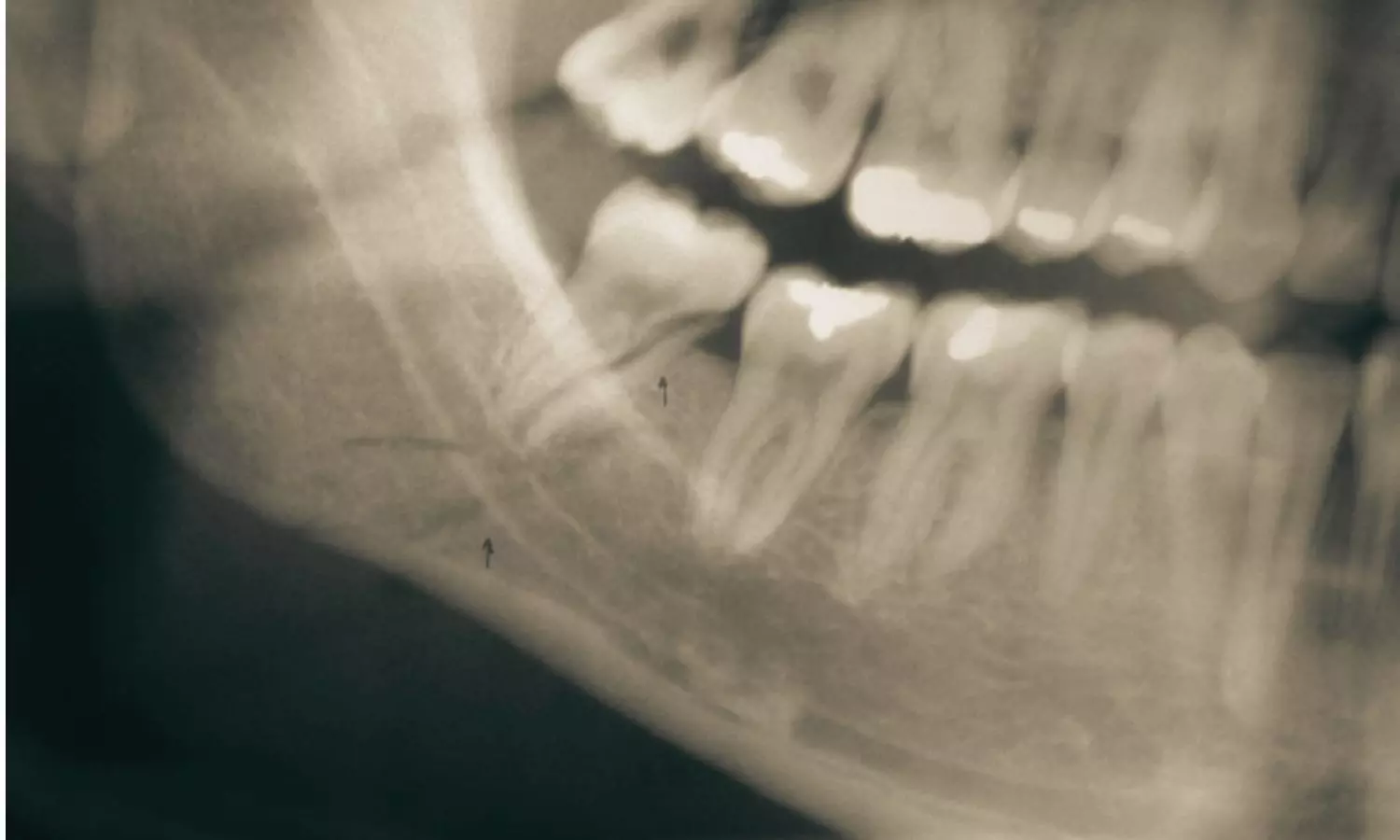 Implant Design and Fixation Technique Influence Mandibular Fracture Stability, Suggests Study Implant Design and Fixation Technique Influence Mandibular Fracture Stability, Suggests Study