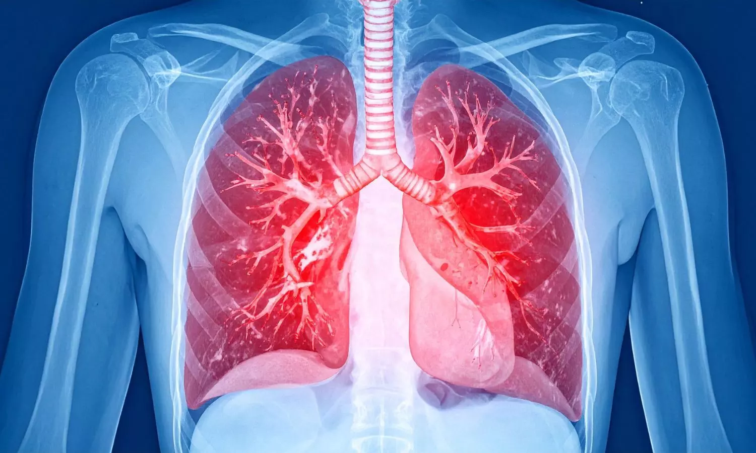 Oral Levosimendan Misses Primary Endpoint in Phase III Trial of HFpEF-Related Pulmonary Hypertension Oral Levosimendan Misses Primary Endpoint in Phase III Trial of HFpEF-Related Pulmonary Hypertension
