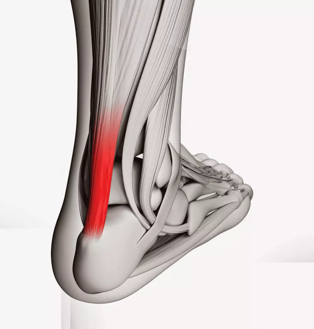PRP added no measurable clinical benefits in nonoperative treatments of Achilles Tendon Rupture: study