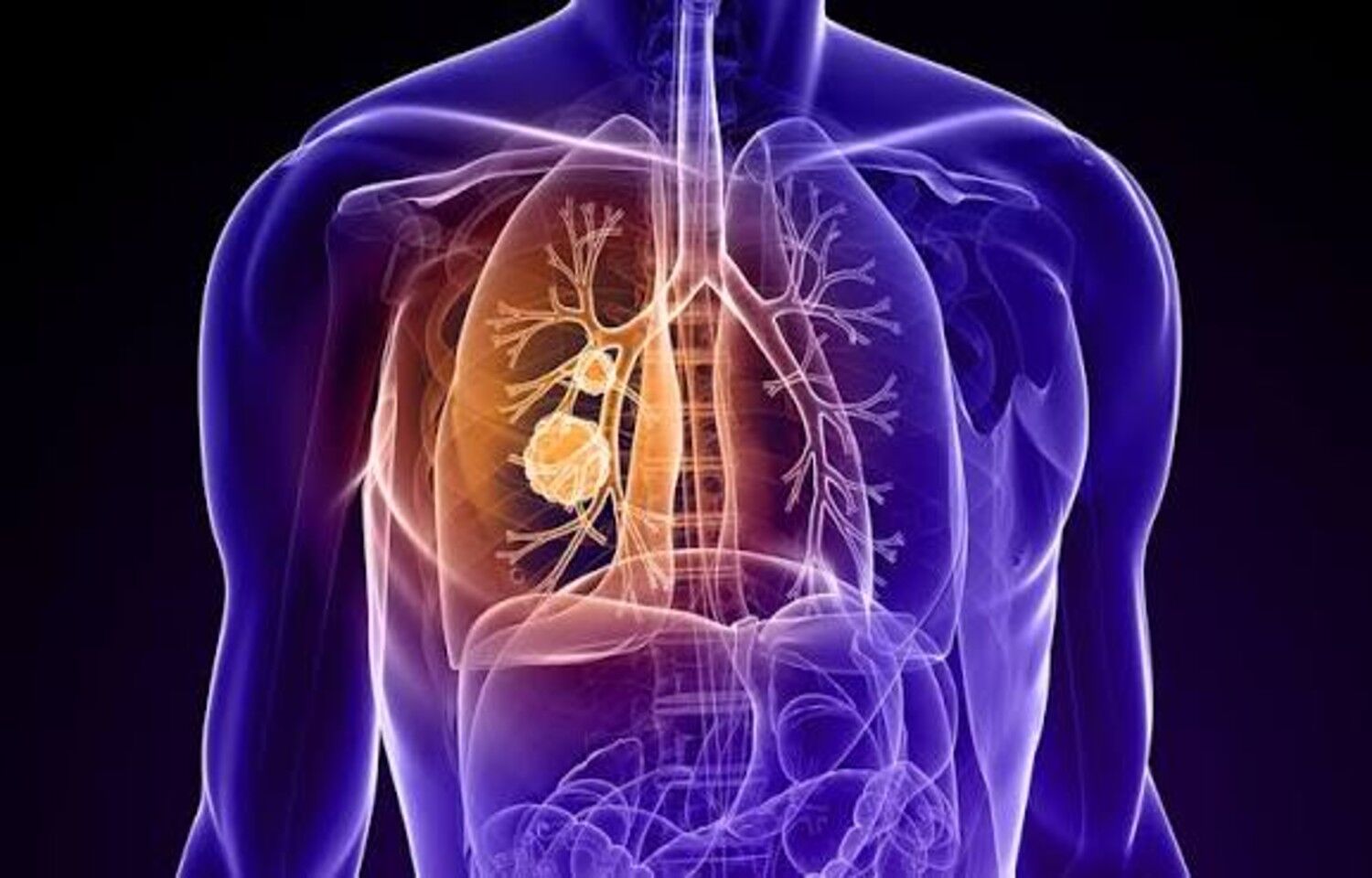 Lung Transplant May Improve Early Survival in Selected Stage IV NSCLC: Study