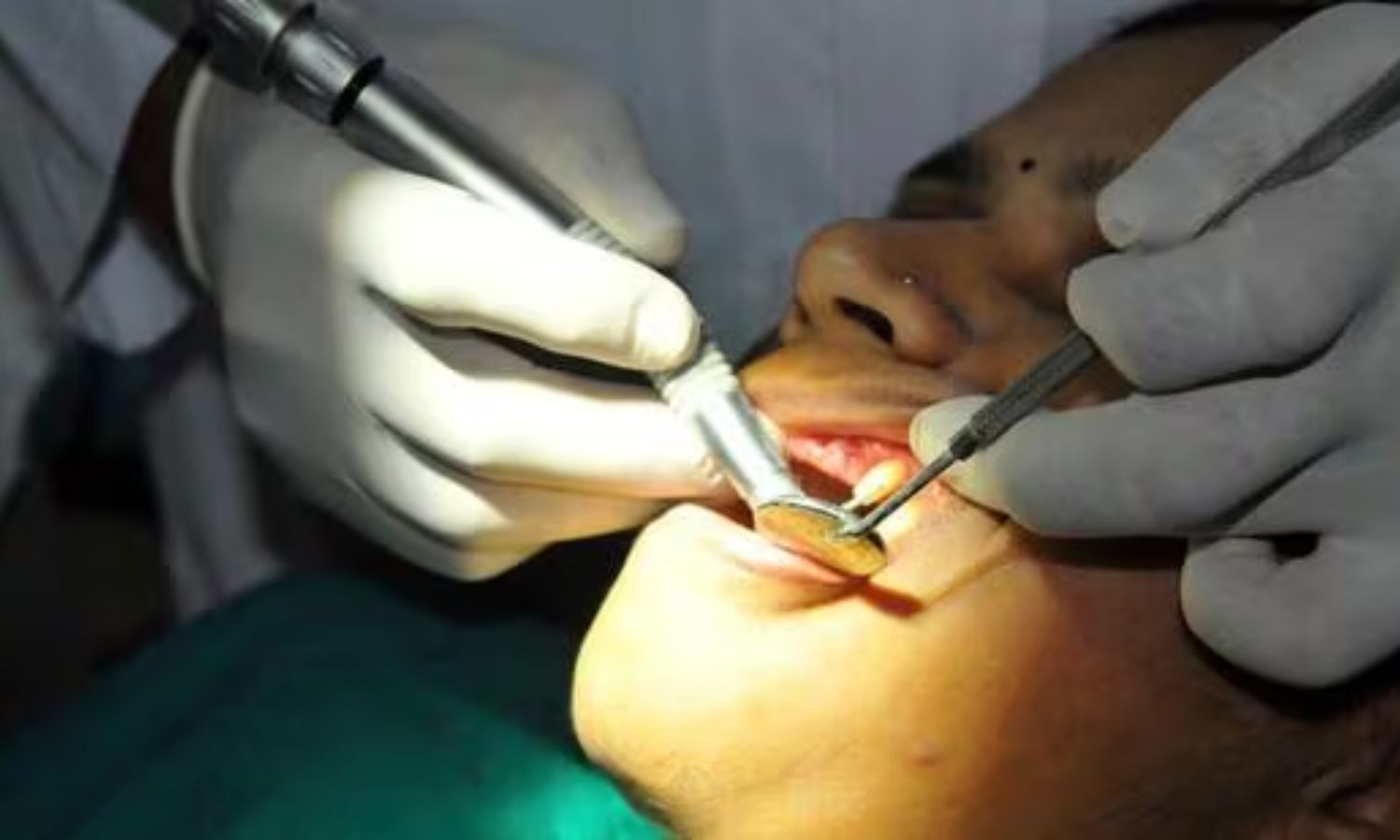 Staff shortage hits prosthetic services at Coimbatore Medical College Hospital Dental Centre