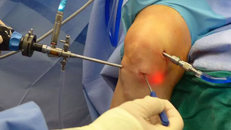 Nadroparin Calcium better than Enoxaparin Sodium in preventing DVT after ACLR: study