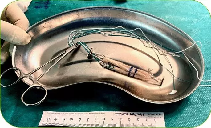 Vancomycin-Soaked Quadriceps Grafts Linked to Early Resorption in ACLR: study