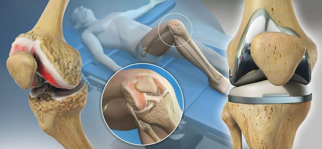 Anterior vs Posterior Referencing for knee sizing Shows Similar TKA Outcomes: study