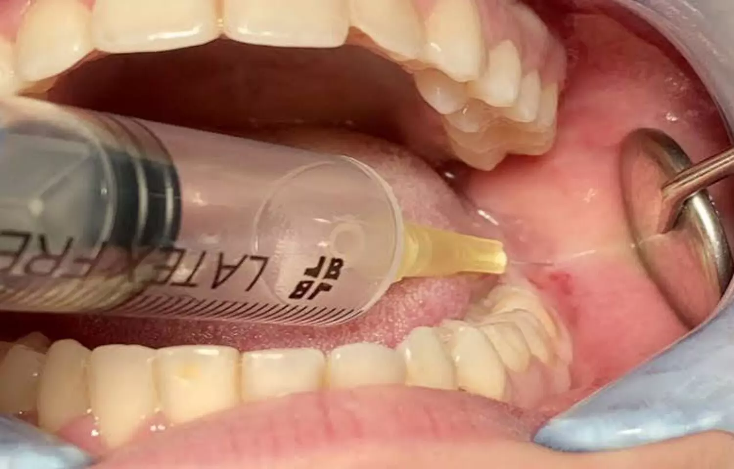 Low-Temperature Saline Irrigation after 3rd molar surgery May Reduce Postoperative Pain: Study