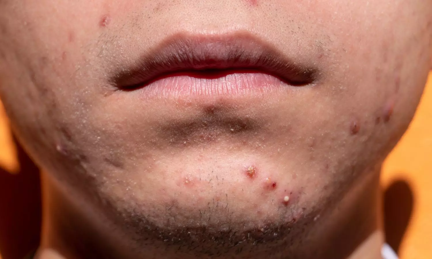 Plain Paper Sticker Improves Accuracy of Infrared Imaging for Skin Lesions: Study